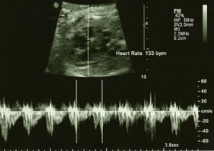 heart rate third trimester